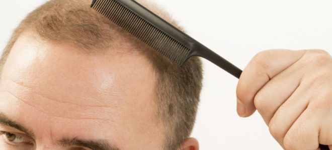 A Few of the Benefits of Getting a Hair Transplant in Washington, DC