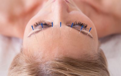 Acupuncture in Chicago: Your Natural Path to Wellness and Healing